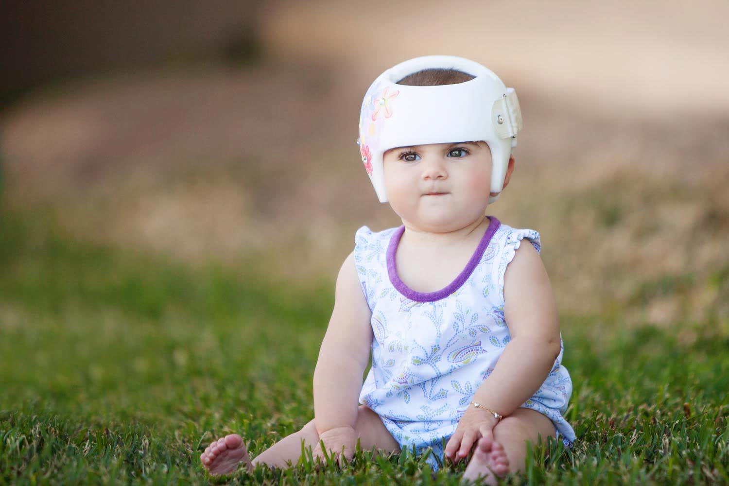 A baby in a Kiddie Cranials cranial band